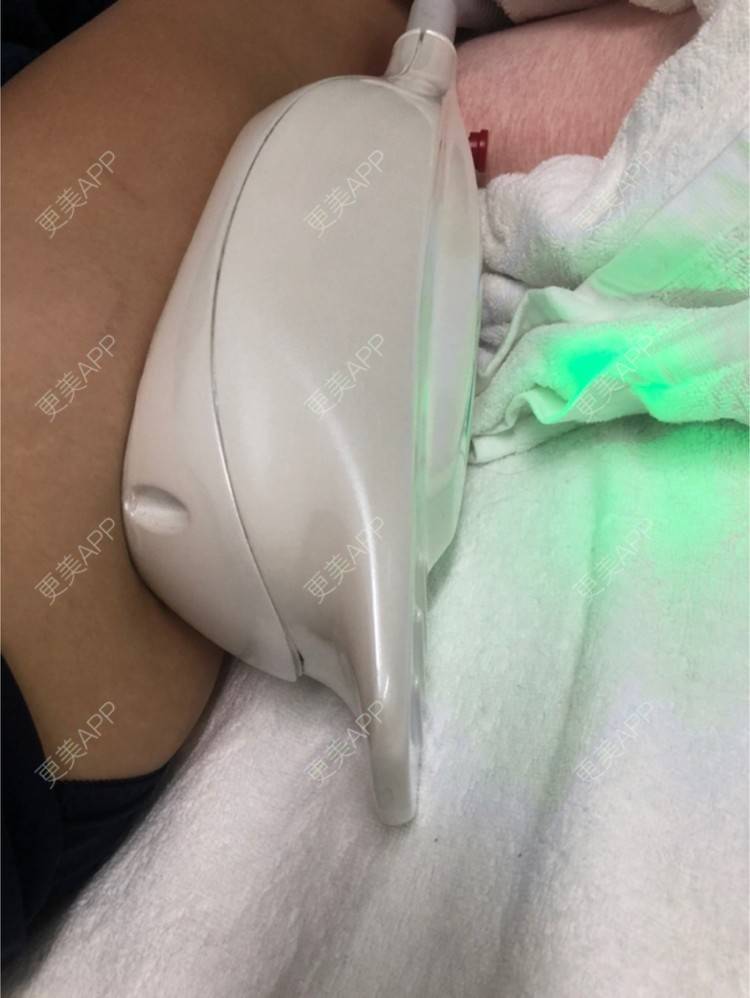 更美 - 捺思的冷冻溶脂经验 | 上海 | 冷冻溶脂