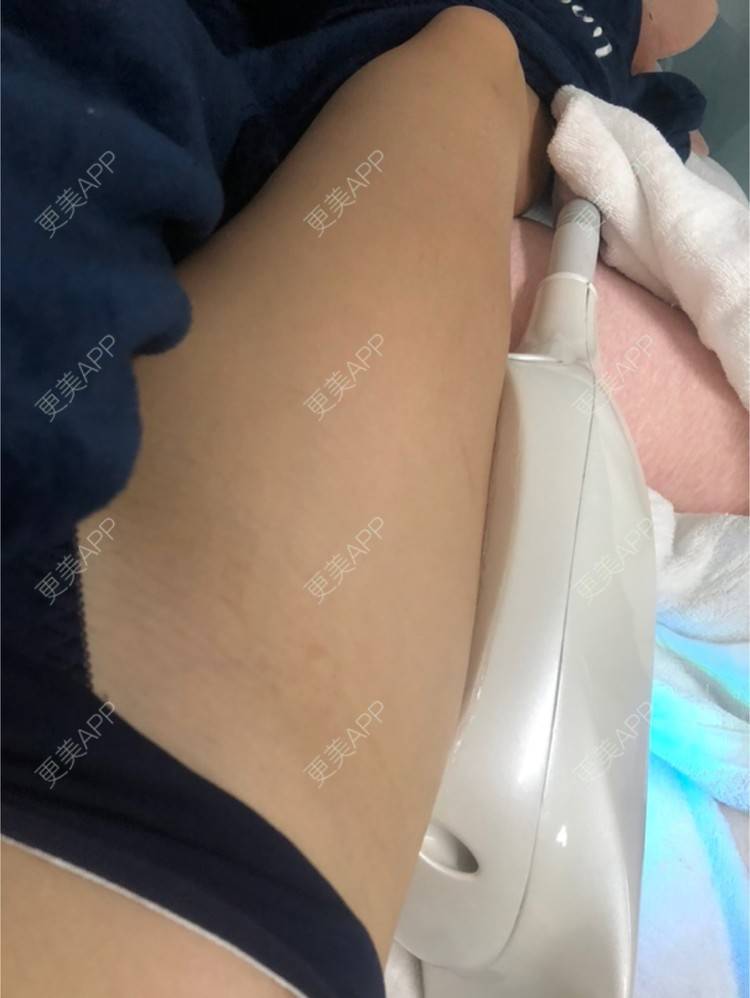 更美 - 捺思的冷冻溶脂经验 | 上海 | 冷冻溶脂