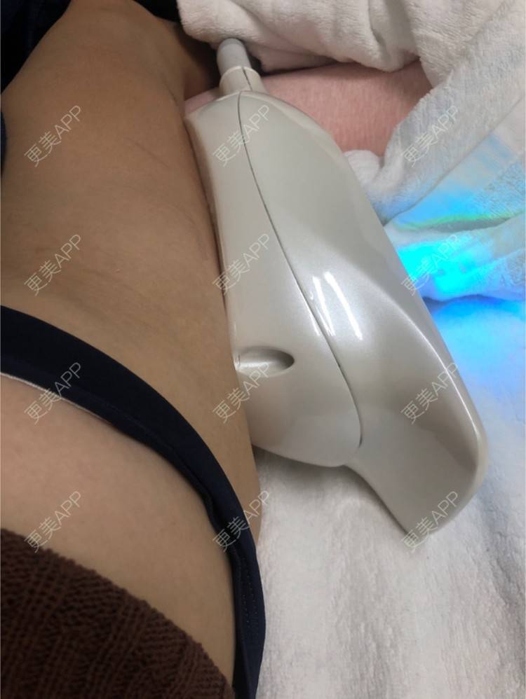 更美 - 捺思的冷冻溶脂经验 | 上海 | 冷冻溶脂