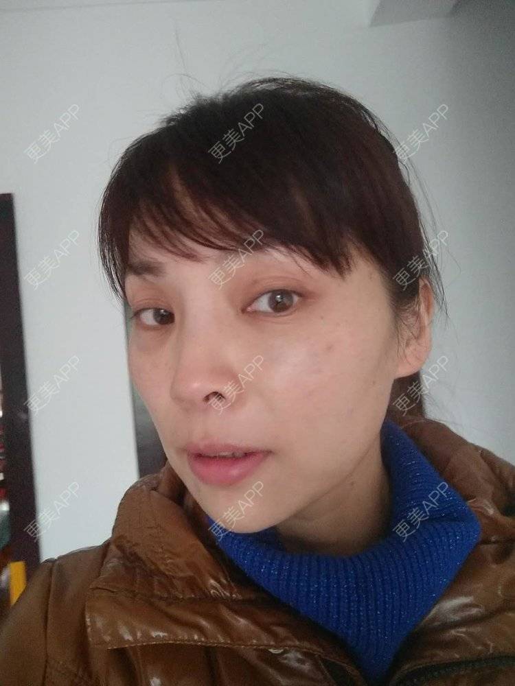 更美 - 更美用户EWi3oovLr0的射频提升经验 | 武汉 | 射频提升