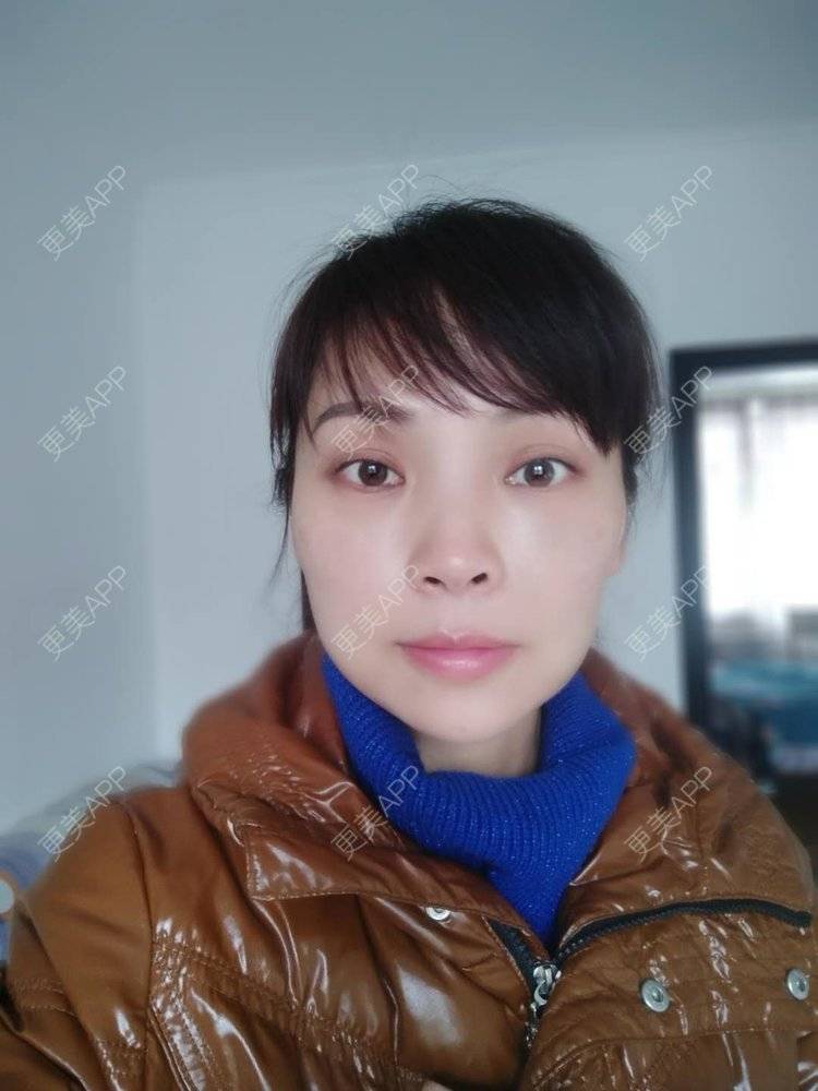 更美 - 更美用户EWi3oovLr0的射频提升经验 | 武汉 | 射频提升