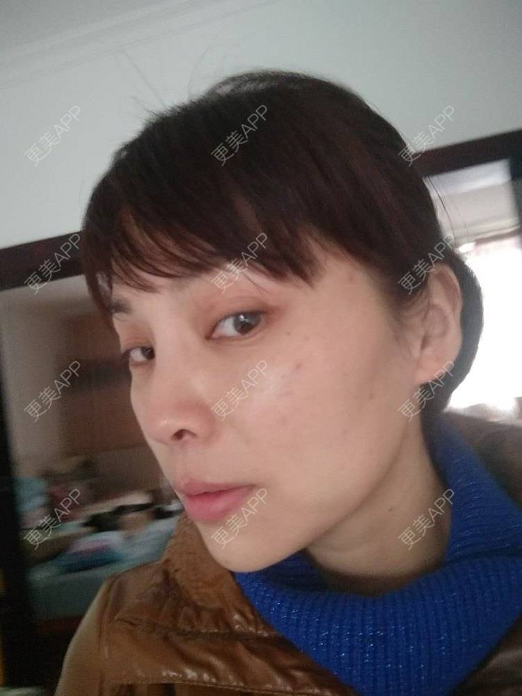 更美 - 更美用户EWi3oovLr0的射频提升经验 | 武汉 | 射频提升