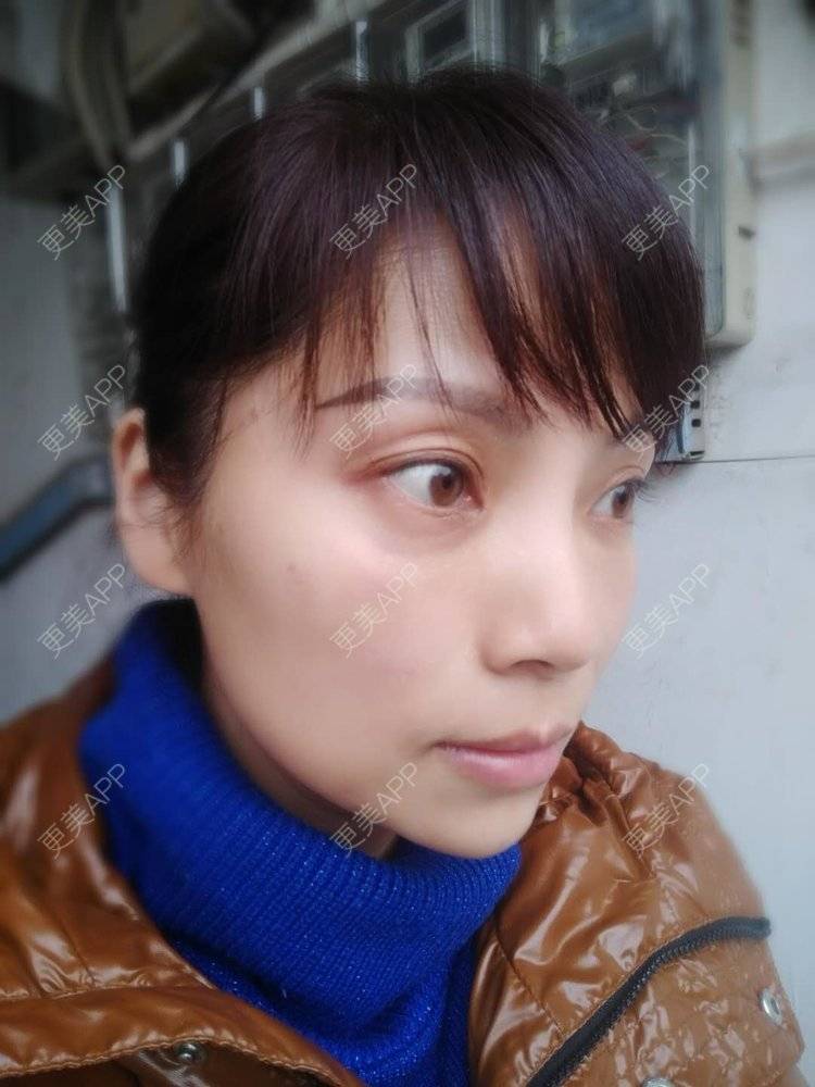 更美 - 更美用户EWi3oovLr0的射频提升经验 | 武汉 | 射频提升