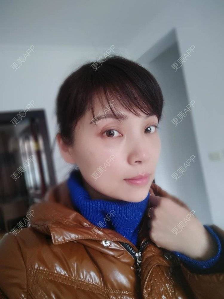 更美 - 更美用户EWi3oovLr0的射频提升经验 | 武汉 | 射频提升