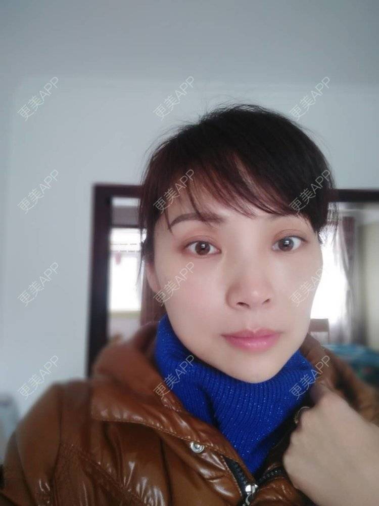 更美 - 更美用户EWi3oovLr0的射频提升经验 | 武汉 | 射频提升