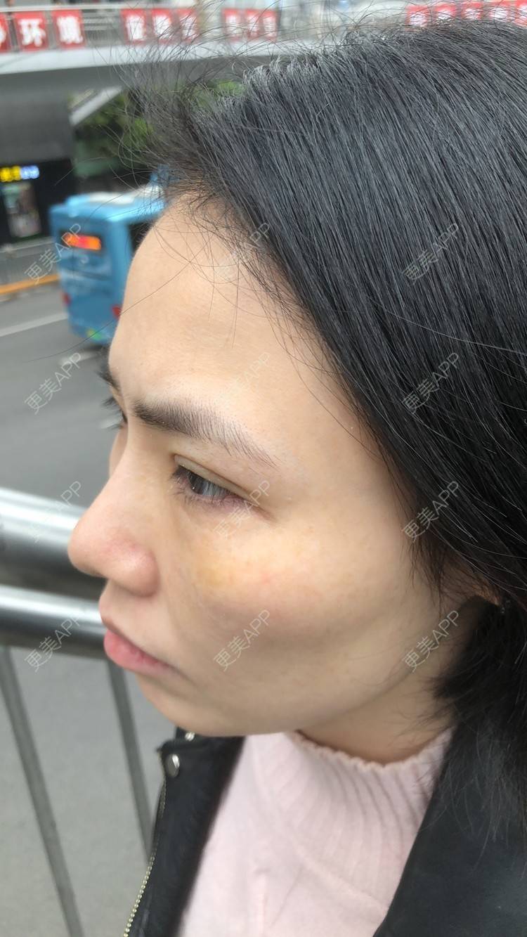 alicess的内切去眼袋日记
