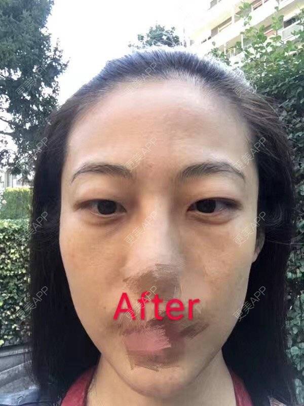 更美 - 悦怡姐姐的激光去眼袋经验 | 激光去眼袋 | 上海