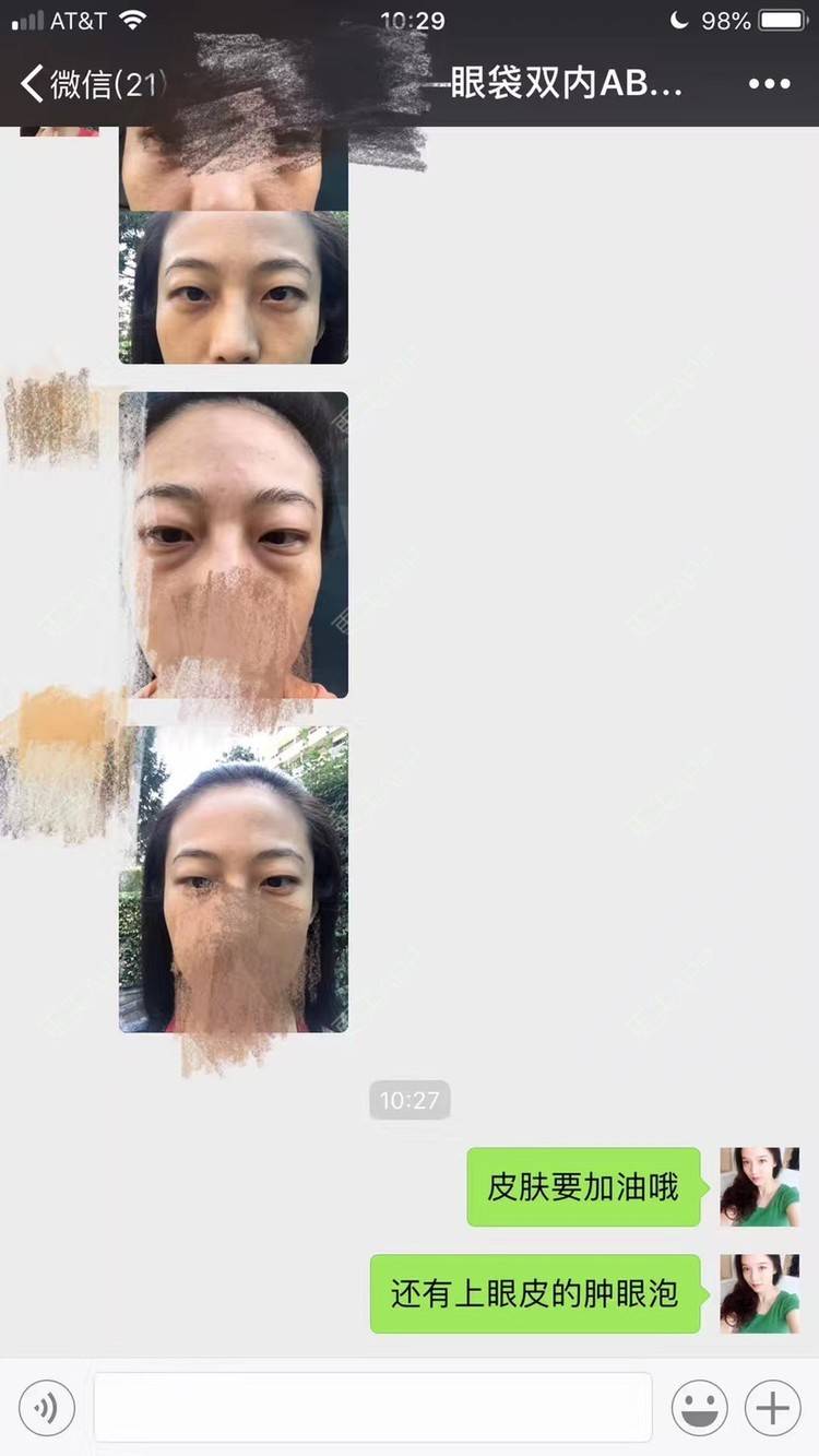 更美 - 悦怡姐姐的激光去眼袋经验 | 激光去眼袋 | 上海