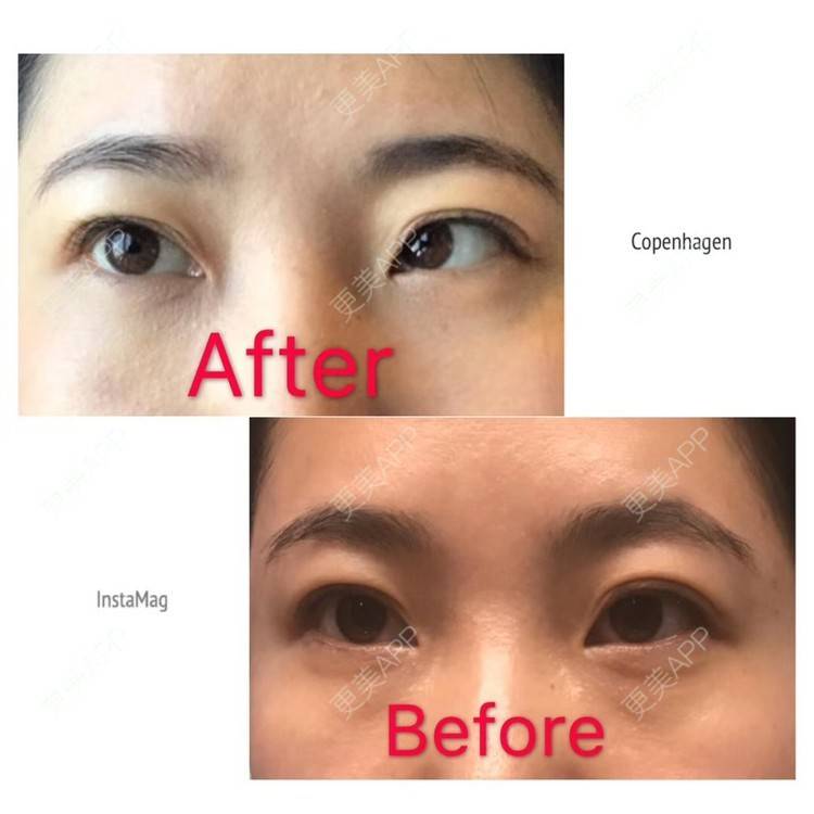 更美 - 悦怡姐姐的激光去眼袋经验 | 激光去眼袋 | 上海