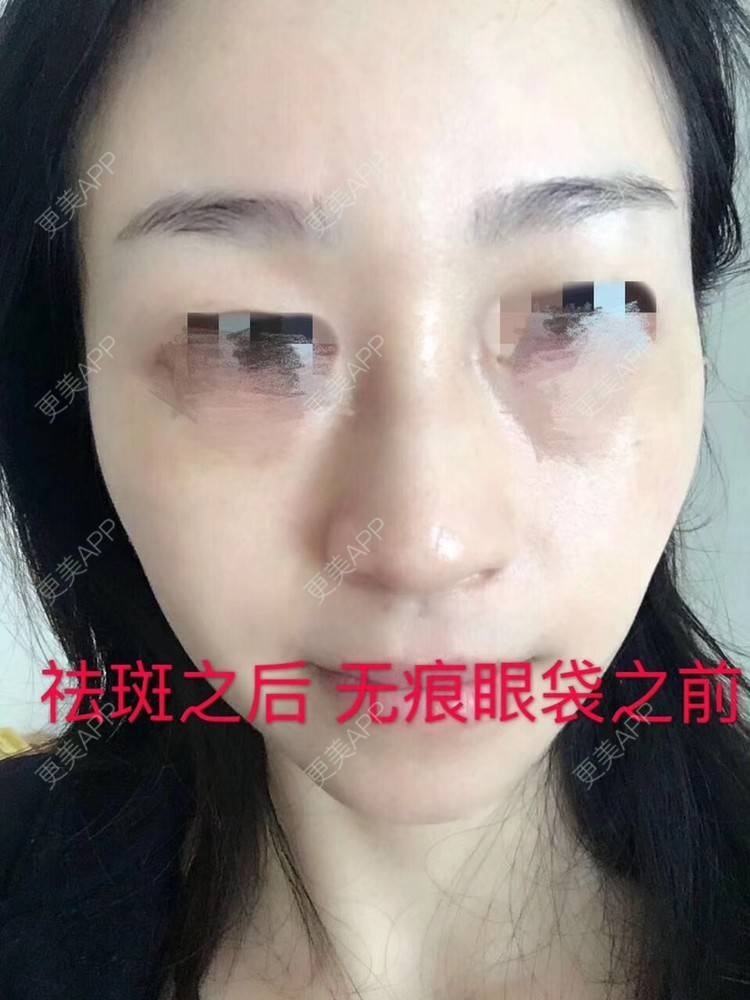 更美 - 悦怡姐姐的激光去眼袋经验 | 激光去眼袋 | 皮肤综合管理套餐 | 皮秒激光 | 上海