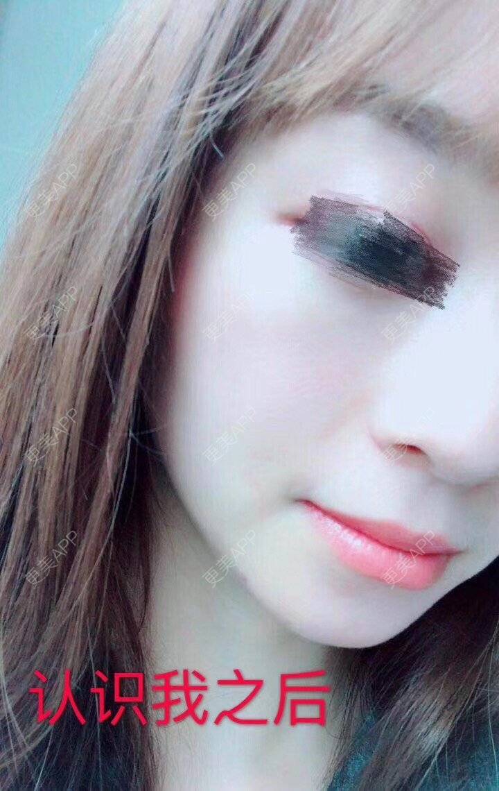 更美 - 悦怡姐姐的激光去眼袋经验 | 激光去眼袋 | 皮肤综合管理套餐 | 皮秒激光 | 上海