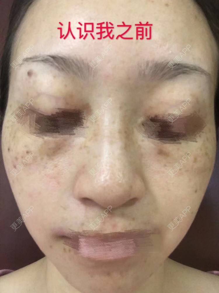 更美 - 悦怡姐姐的激光去眼袋经验 | 激光去眼袋 | 皮肤综合管理套餐 | 皮秒激光 | 上海