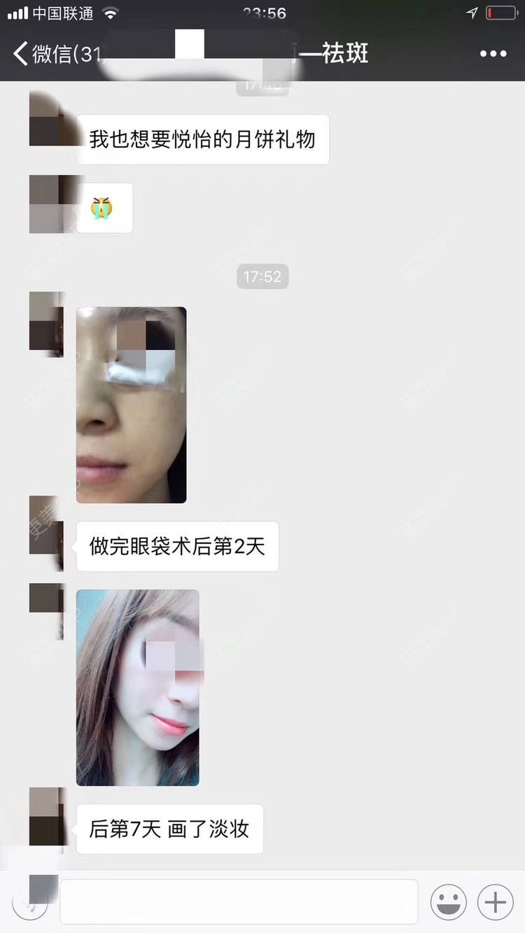 更美 - 悦怡姐姐的激光去眼袋经验 | 激光去眼袋 | 皮肤综合管理套餐 | 皮秒激光 | 上海