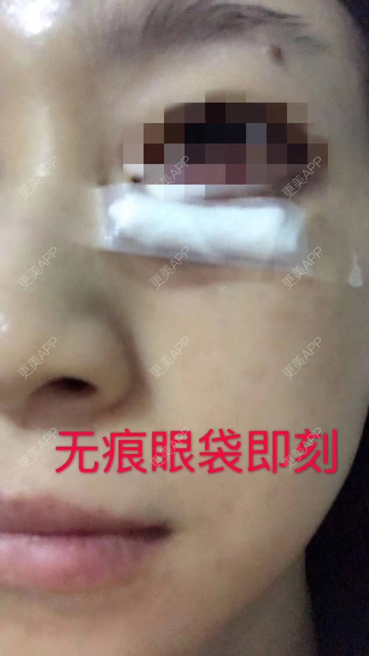 更美 - 悦怡姐姐的激光去眼袋经验 | 激光去眼袋 | 皮肤综合管理套餐 | 皮秒激光 | 上海