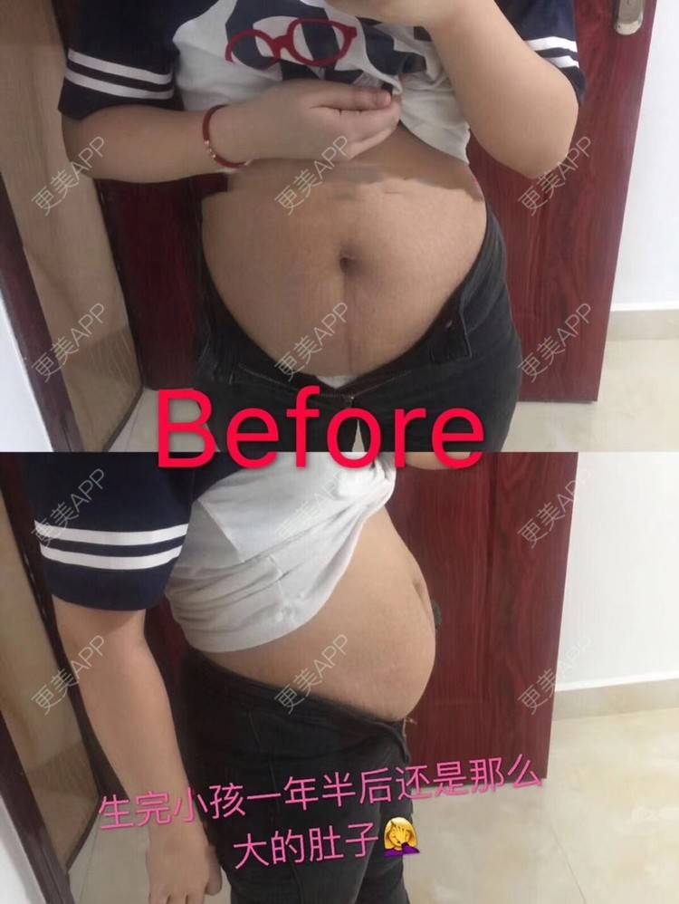 更美 - 悦怡姐姐的妊娠纹经验 | 妊娠纹 | 上海