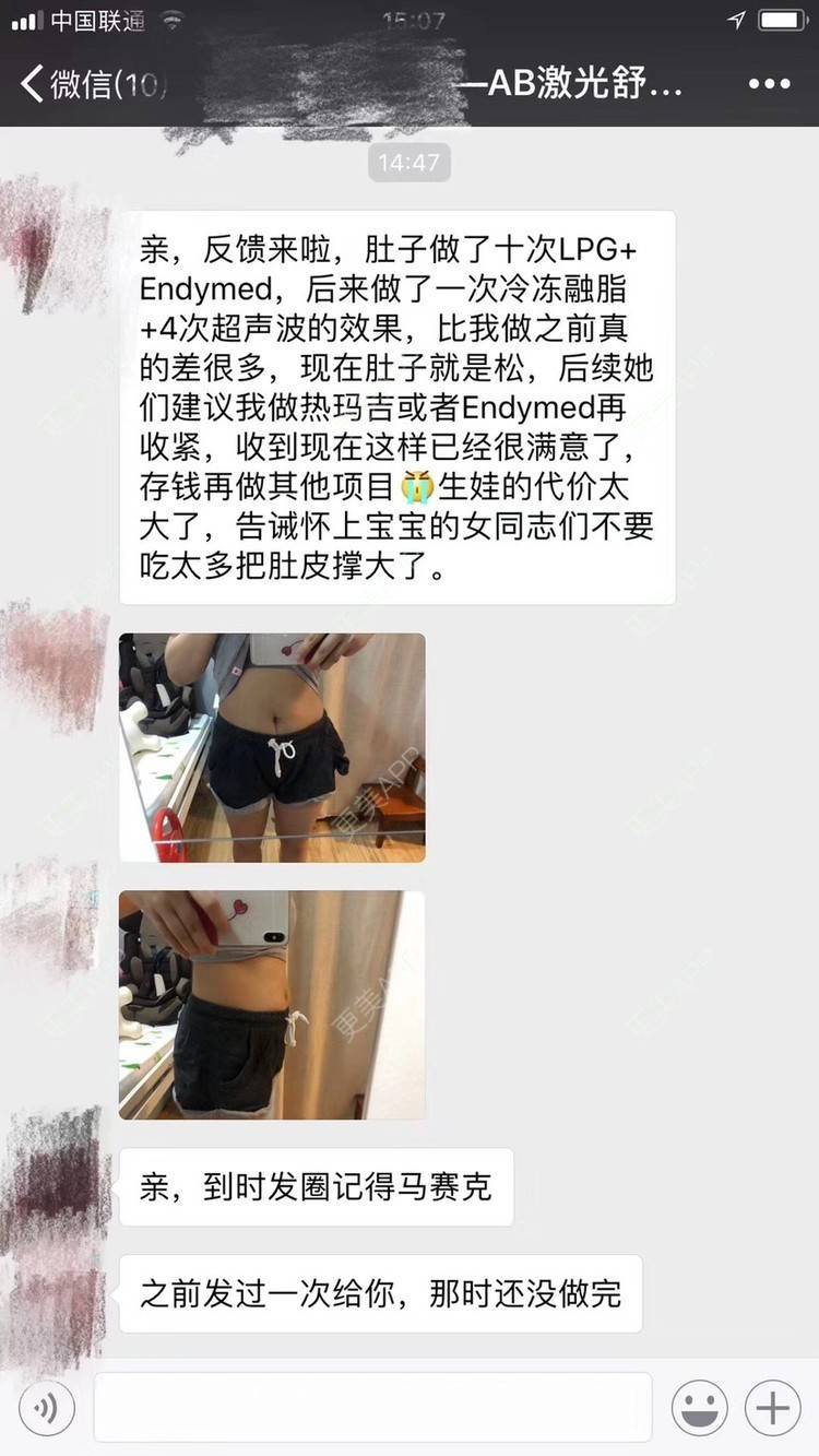 更美 - 悦怡姐姐的妊娠纹经验 | 妊娠纹 | 上海