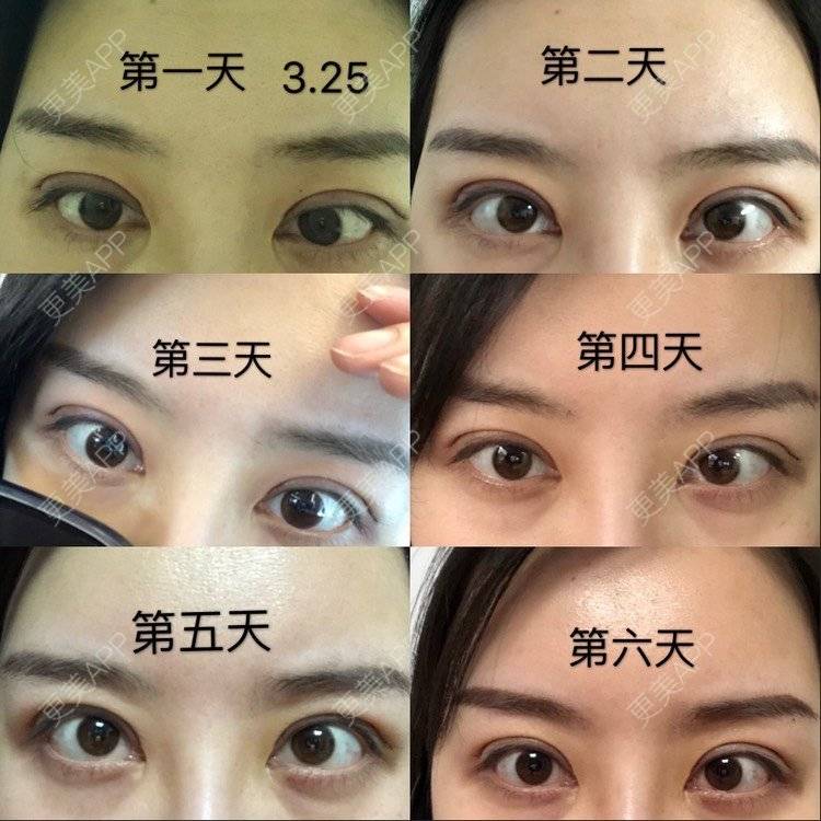更美 - 10yu的双眼皮修复经验 | 双眼皮修复 | 眶隔脂肪释放 | 上海
