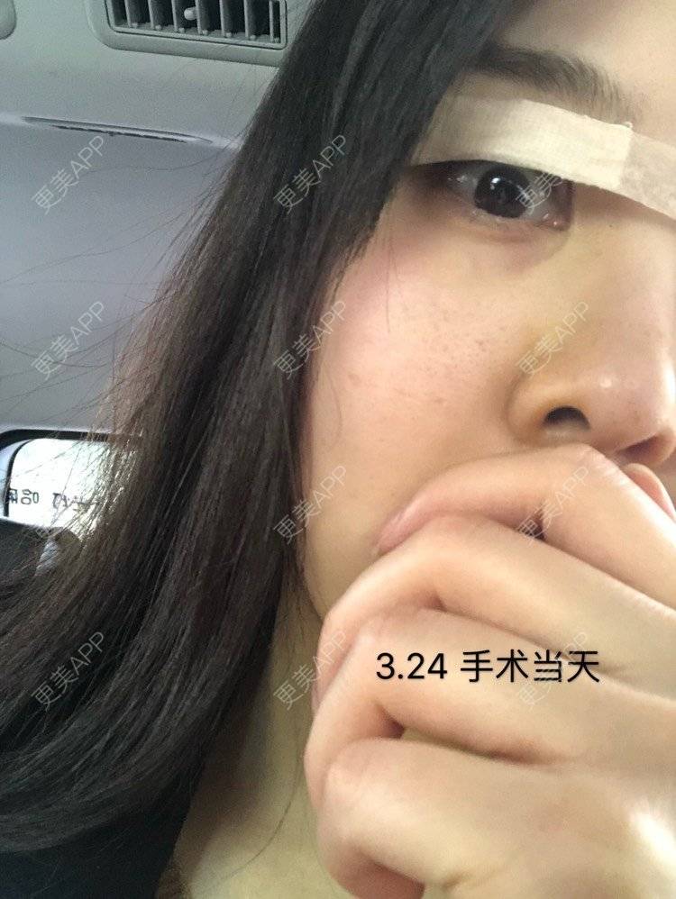 更美 - 10yu的双眼皮修复经验 | 双眼皮修复 | 眶隔脂肪释放 | 上海