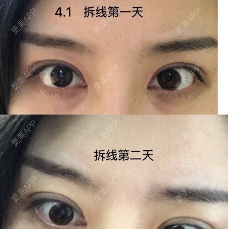 更美 - 10yu的双眼皮修复经验 | 上海 | 双眼皮修复 | 眶隔脂肪释放