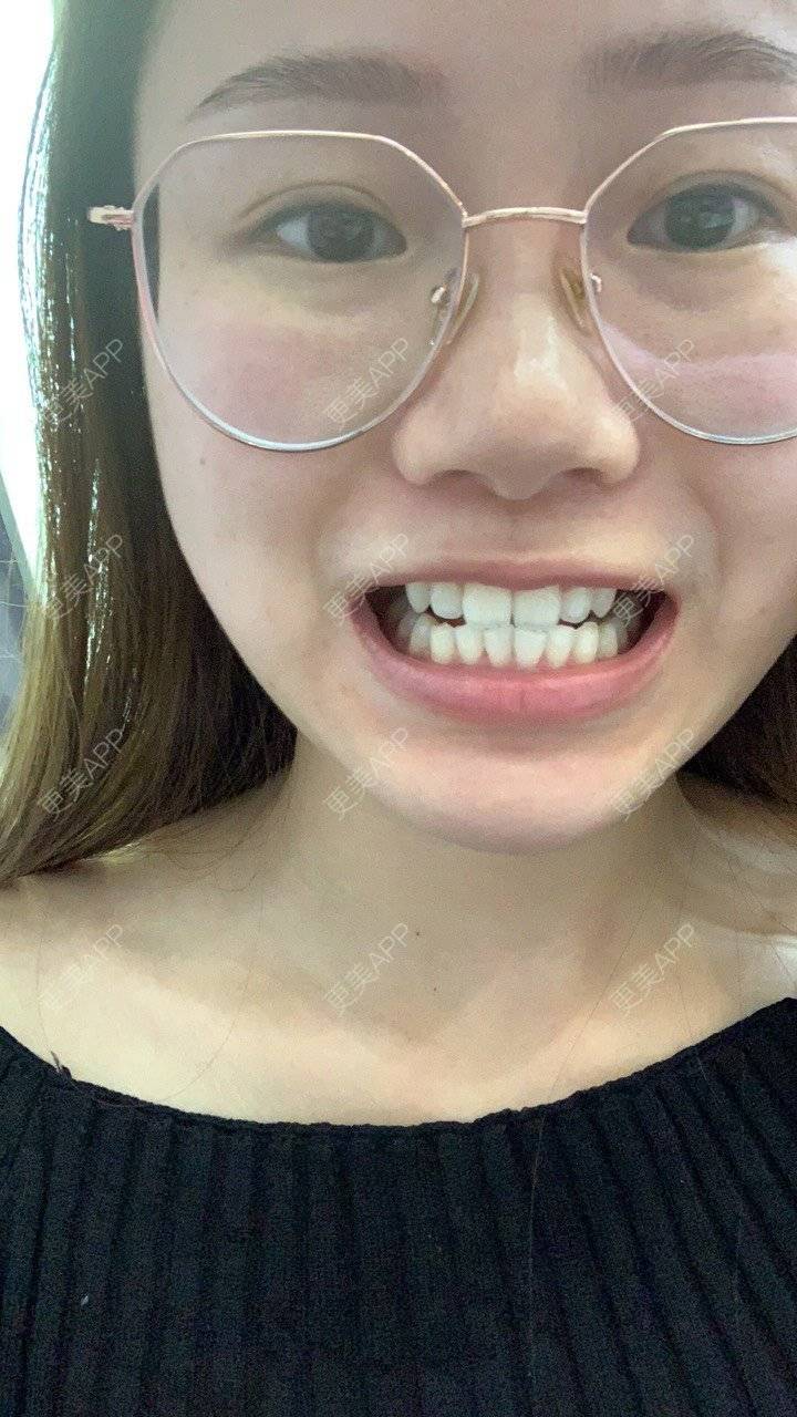 更美 - ahah的牙齿矫正经验 | 牙齿矫正 | 广州