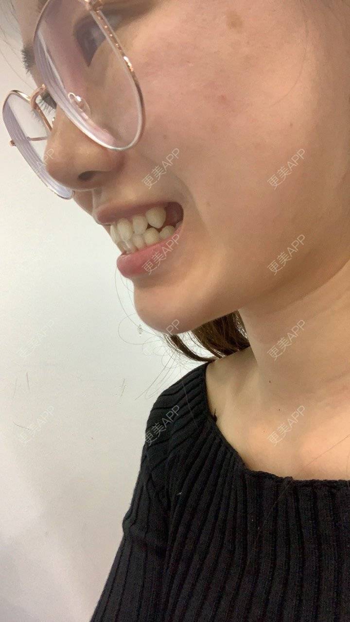 更美 - ahah的牙齿矫正经验 | 牙齿矫正 | 广州