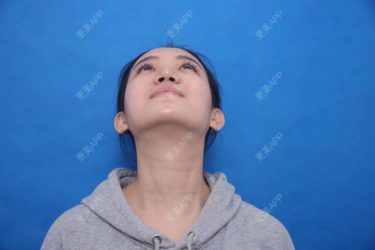 更美 - 瑶瑶就要瑶瑶的颈部经验 | 广州 | 玻尿酸颈纹 | 颈部