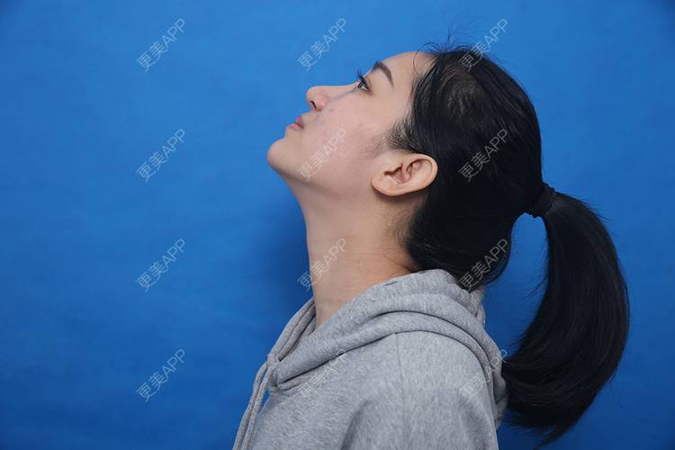 更美 - 瑶瑶就要瑶瑶的颈部经验 | 广州 | 玻尿酸颈纹 | 颈部
