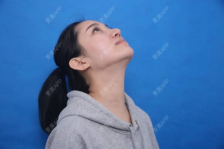 更美 - 瑶瑶就要瑶瑶的颈部经验 | 广州 | 玻尿酸颈纹 | 颈部
