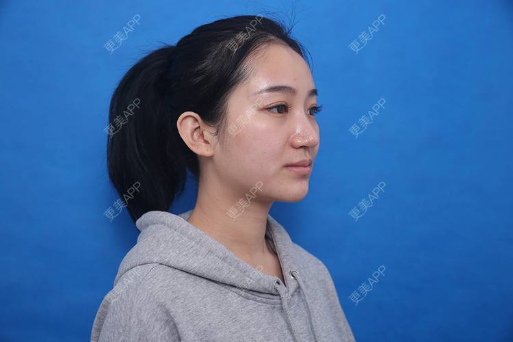 更美 - 瑶瑶就要瑶瑶的颈部经验 | 广州 | 玻尿酸颈纹 | 颈部