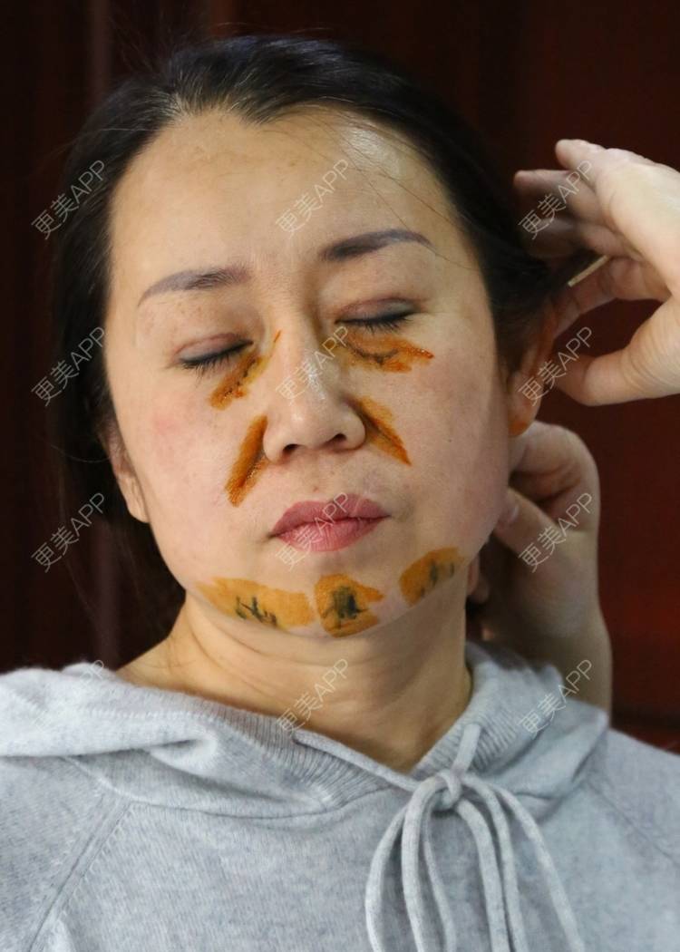更美 - 凤凰飞枝头的拉皮经验 | 北京 | 拉皮