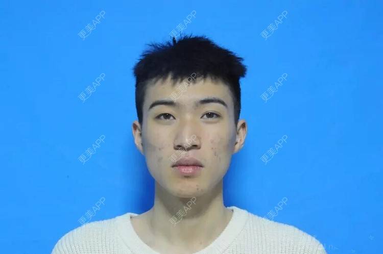 更美 - 更美用户JKnbUZGsXV的果酸焕肤经验 | 果酸焕肤 | 重庆