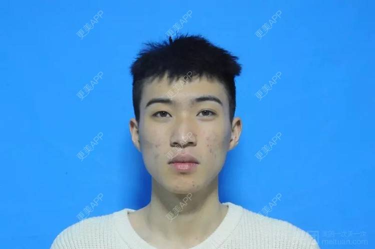 更美 - 更美用户1vAhZRoKts的果酸焕肤经验 | 果酸焕肤 | 重庆