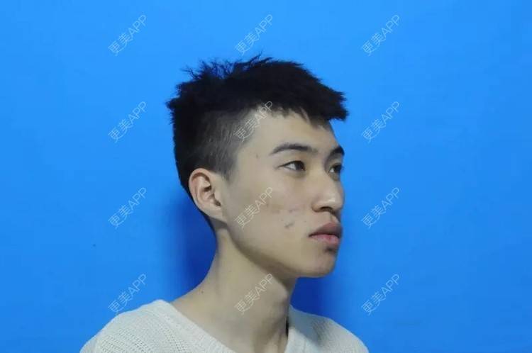 更美 - 更美用户1vAhZRoKts的果酸焕肤经验 | 重庆 | 果酸焕肤