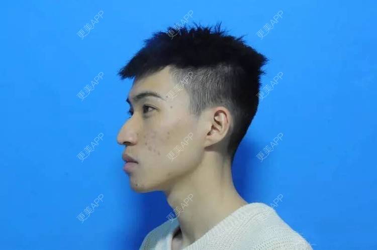 更美 - 更美用户1vAhZRoKts的果酸焕肤经验 | 重庆 | 果酸焕肤