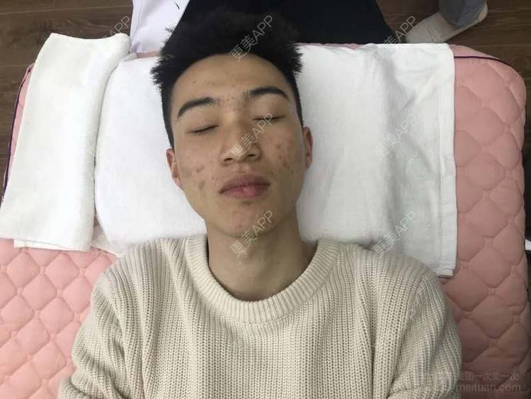 更美 - 更美用户1vAhZRoKts的果酸焕肤经验 | 重庆 | 果酸焕肤