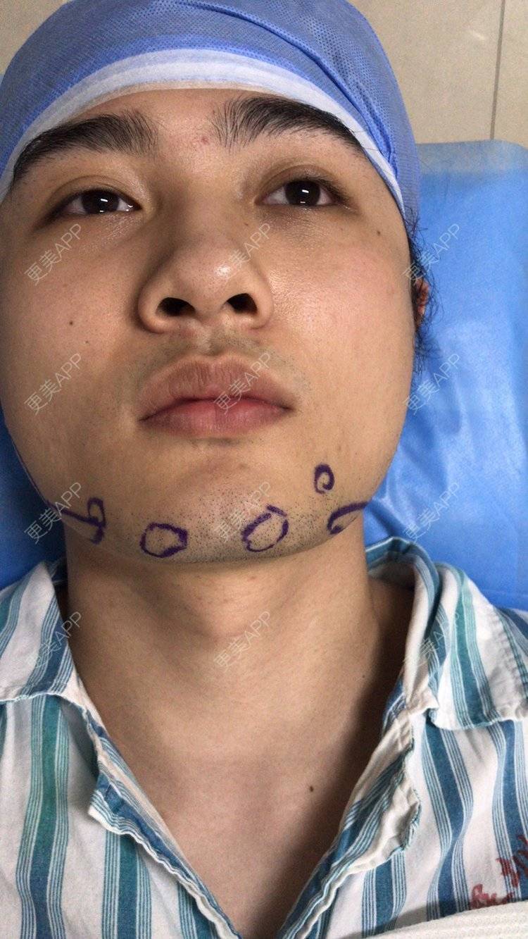 安和桥的桥的下颌角切除日记