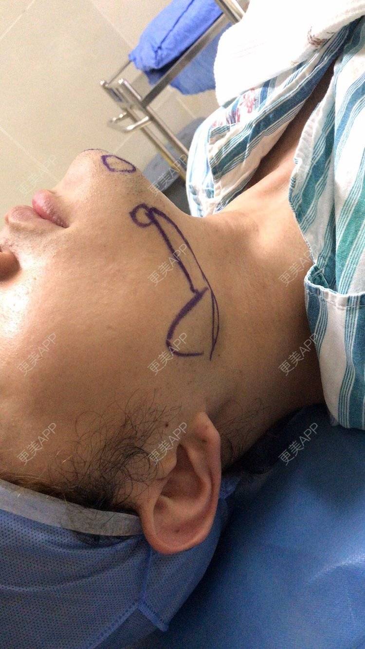 安和桥的桥的下颌角切除日记