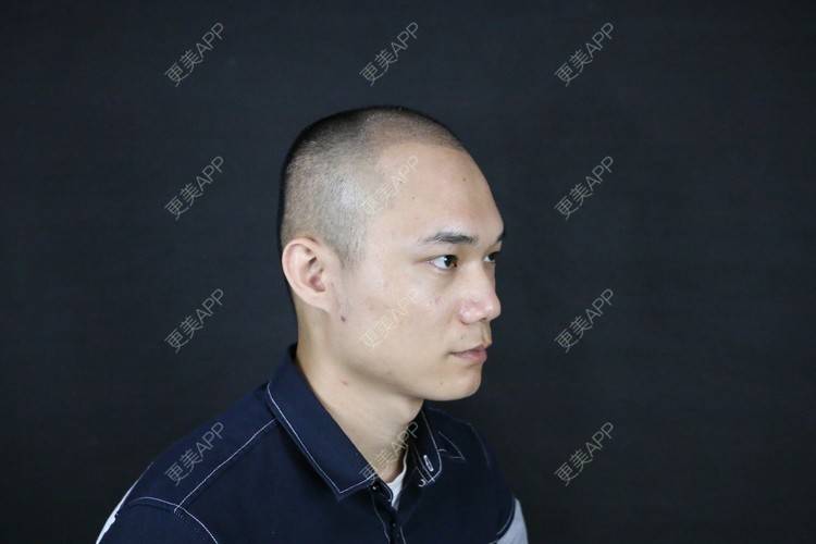 更美 - 更美用户y5O1wsEQkc的鬓角植发经验 | 广州 | 视频日记 | 鬓角植发