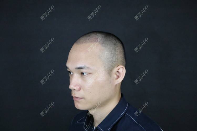 更美 - 更美用户y5O1wsEQkc的鬓角植发经验 | 广州 | 视频日记 | 鬓角植发