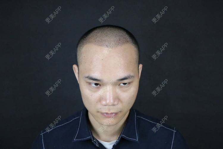 更美 - 更美用户y5O1wsEQkc的鬓角植发经验 | 广州 | 视频日记 | 鬓角植发