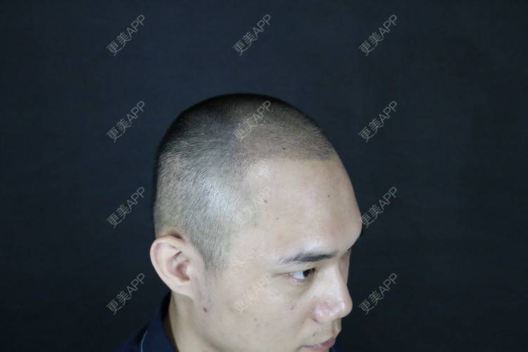 更美 - 更美用户y5O1wsEQkc的鬓角植发经验 | 广州 | 视频日记 | 鬓角植发