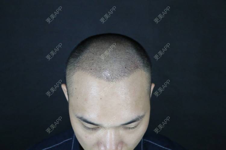 更美 - 更美用户y5O1wsEQkc的鬓角植发经验 | 广州 | 视频日记 | 鬓角植发