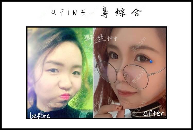 更美 - 车厘子好甜🍒的隆鼻经验 | 隆鼻 | 自体脂肪隆鼻 | 鼻翼缩小 | 广州