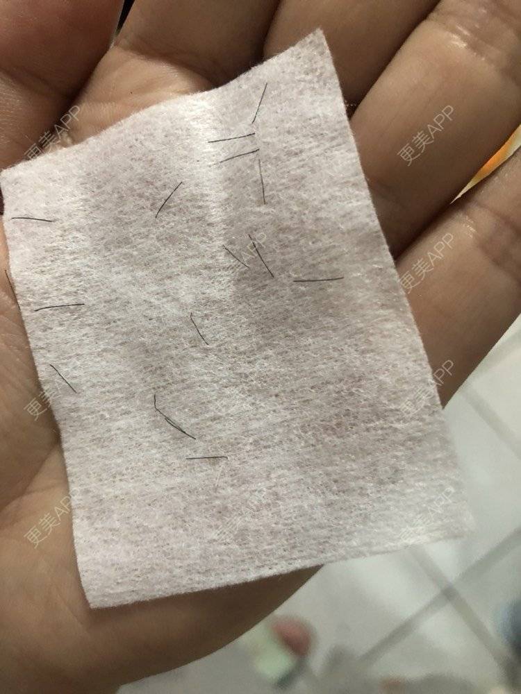 更美 - 奥多Ke。的植发际线经验 | 植发际线 | 南昌