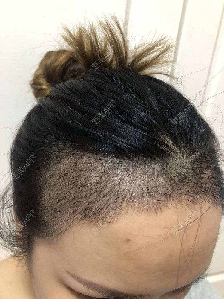 更美 - 奥多Ke。的植发际线经验 | 植发际线 | 南昌