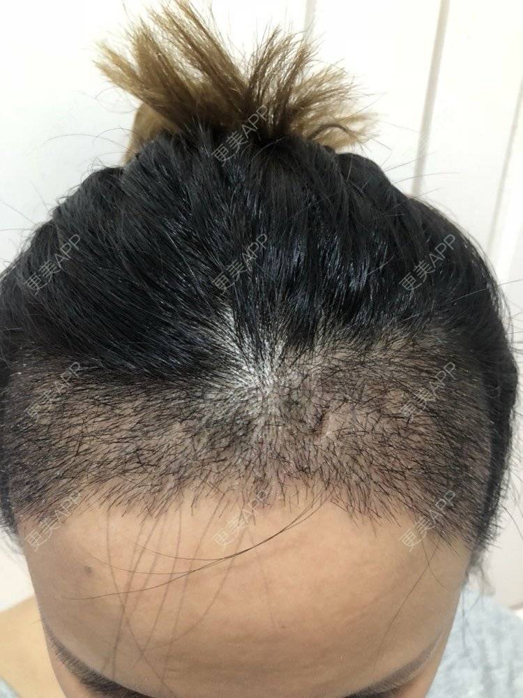 更美 - 奥多Ke。的植发际线经验 | 植发际线 | 南昌