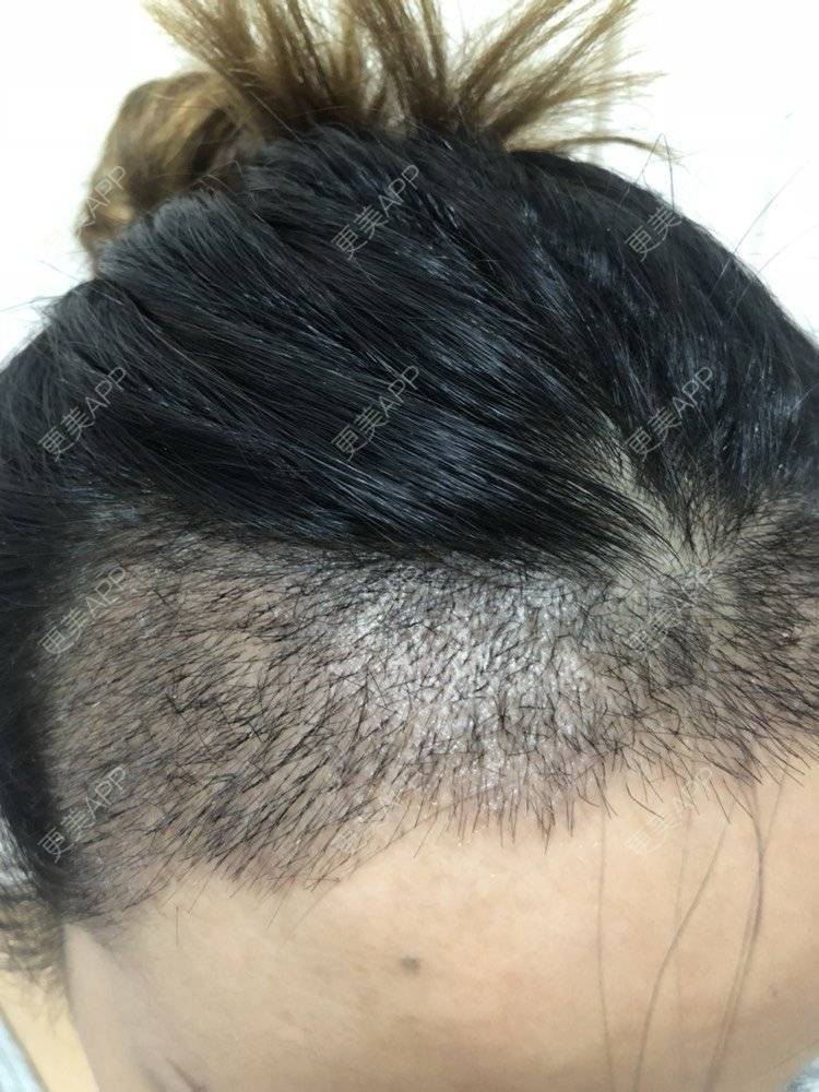 更美 - 奥多Ke。的植发际线经验 | 植发际线 | 南昌