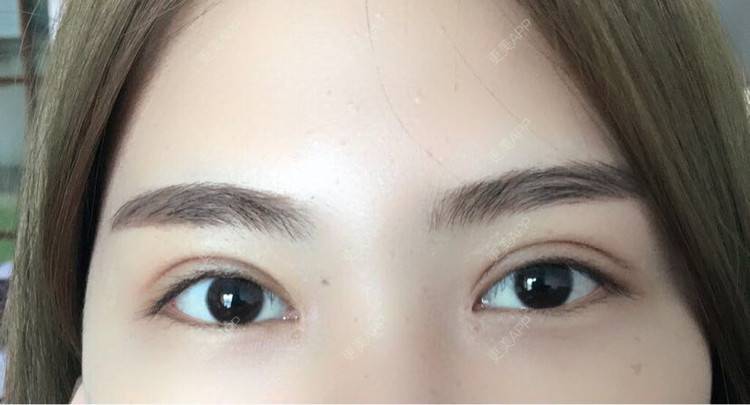 全切双眼皮效果图_满脸都写着高兴全切双眼皮效果图_术后829天__更美