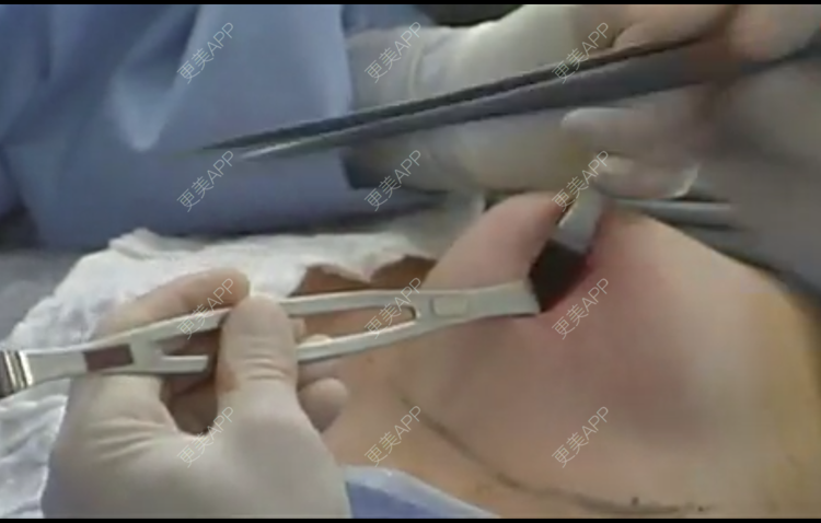 更美 - 回忆没当妈妈前的我的假体隆胸经验 | 假体隆胸 | 玻尿酸乳头