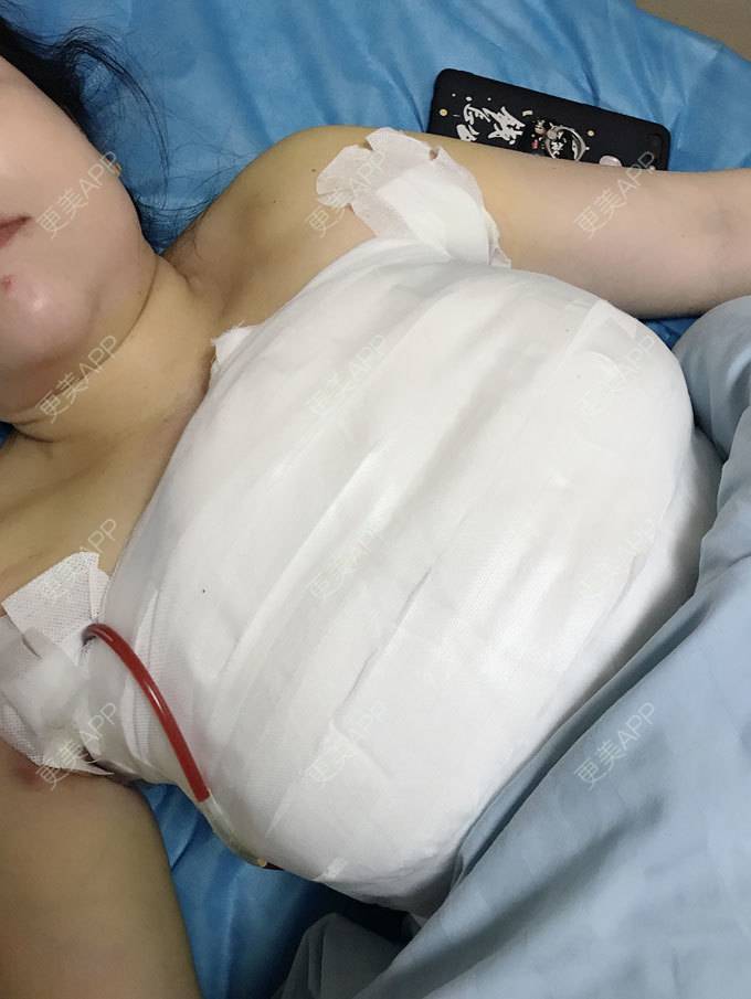 更美 - 木木鹿子的假体隆胸日记 | 假体隆胸 | 广州